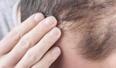 טיפול טבעי לנשירת שיער